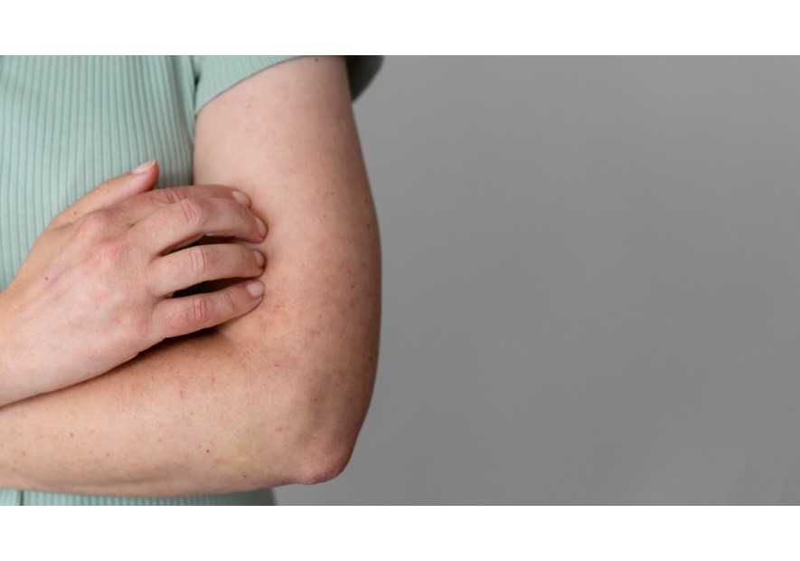 ¿Cómo cuidar tu piel con dermatitis atópica?